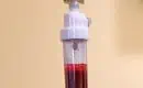 Bright red ozone infused blood drips back into patient